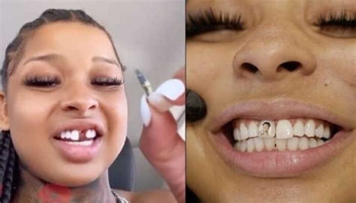 Chrisean Rock missing tooth story explained
