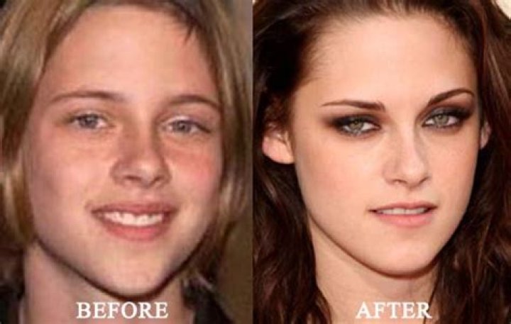 Kristen Stewart Plastic Surgery Before and After